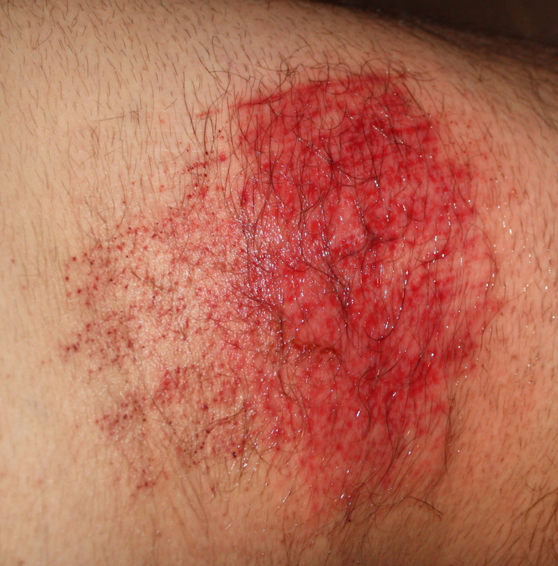 Turf burn when not wearing white tape